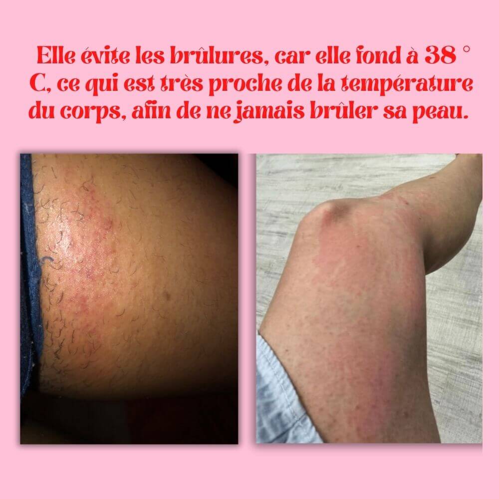 évite les brulure