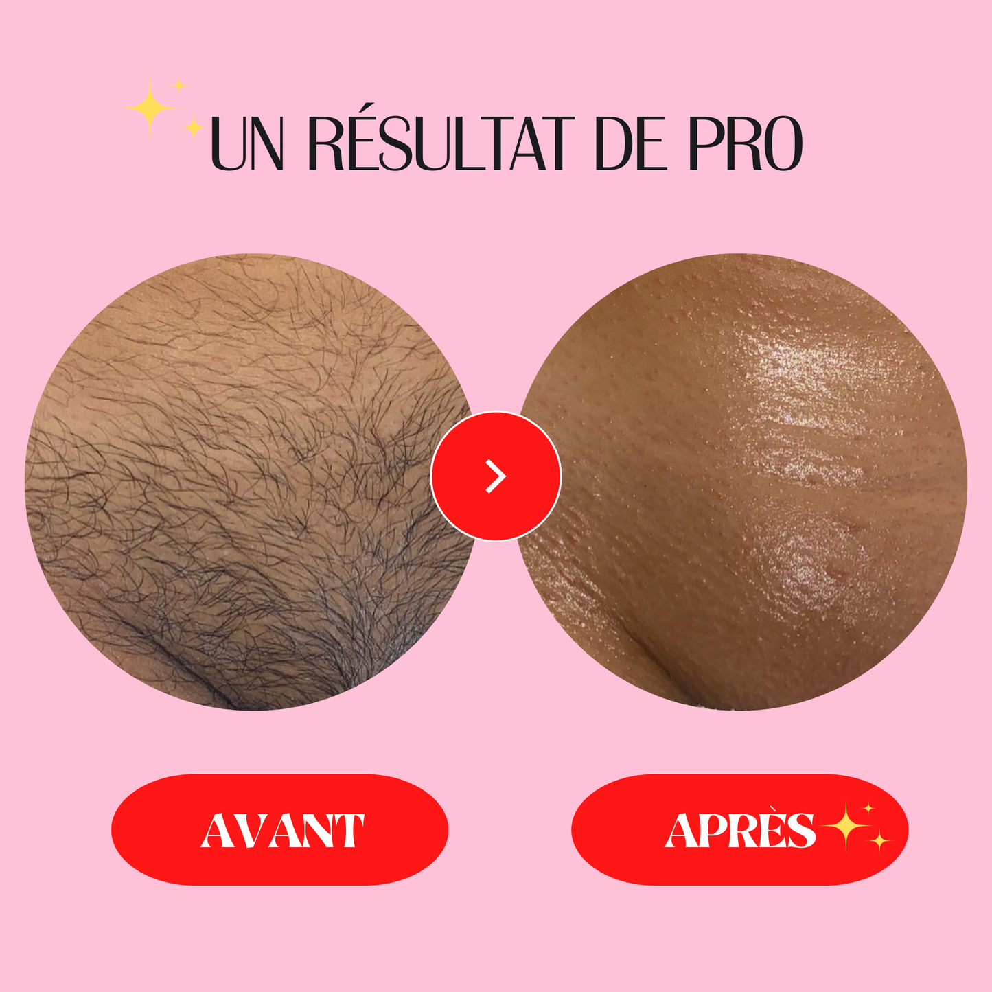 avant_apres_epilation